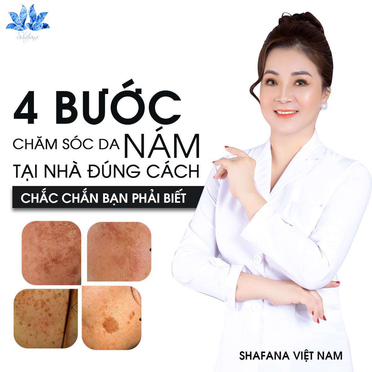 4 bước trị nám mùa hè